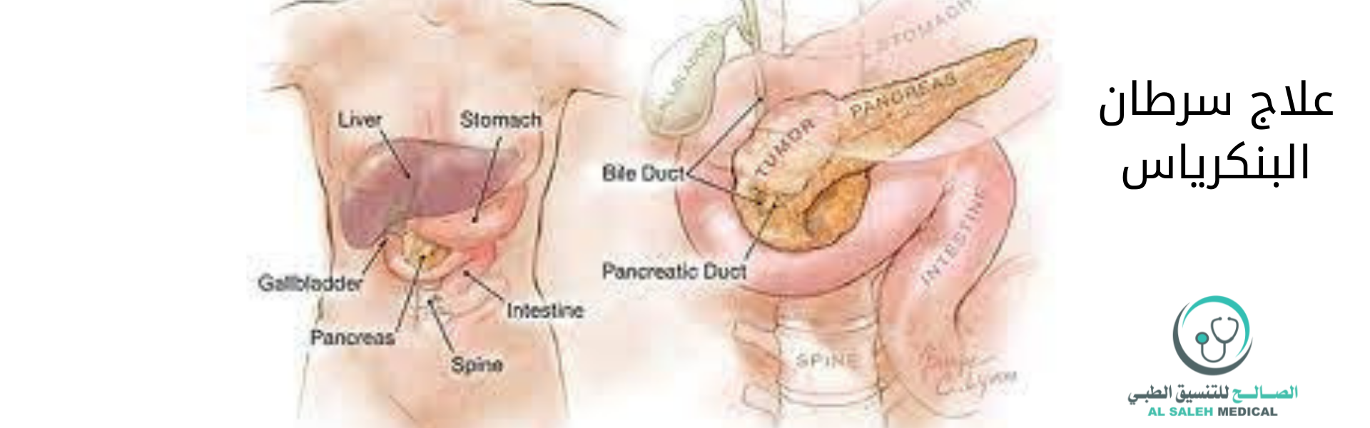 علاج سرطان البنكرياس في الهند| طرق الشخيص وأفضل المستشفيات
